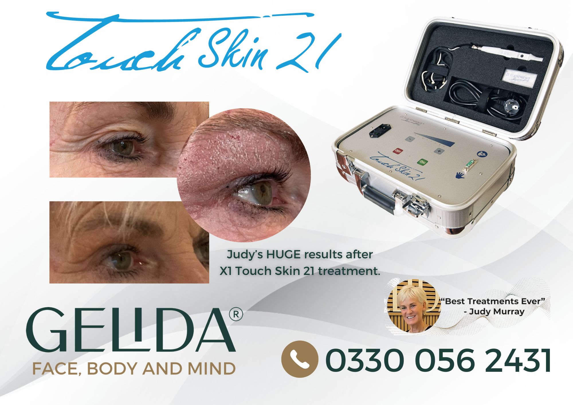 Judy Murray has Gelida Touch Skin eye lid treatment